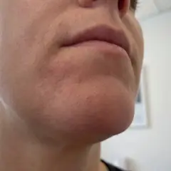 När perioral dermatit stressar huden runt munnen syns rodnad och små utslag.