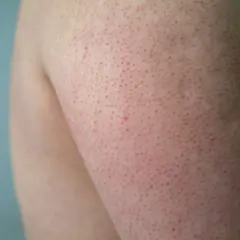Närbild på hud med små röda prickar, liknande keratosis pilaris ansikte, på en arm.