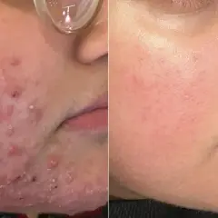 Före- och efterbilder visar ett ansikte med svår akne och rodnad, troligen orsakad av malassezia, som sedan blivit klarare och lugnare.