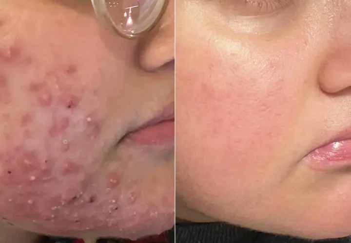 Före- och efterbilder visar ett ansikte med svår akne och rodnad, troligen orsakad av malassezia, som sedan blivit klarare och lugnare.