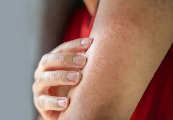 Nära bild på en arm med små knottror som tyder på keratosis pilaris. En hand rör vid huden.