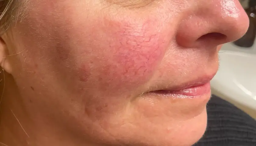 Närbild på en kvinnas kind med synliga röda blodkärl, ett vanligt tecken på rosacea. Fokuserar på hudvård för att hantera tillståndet.
