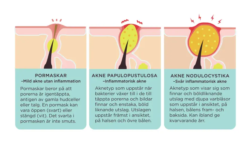 Illustrationer visar olika typer av finnar på huden, från milda pormaskar till svår akne med bölder. Finnar på halsen kan vara ett tecken på inflammatorisk akne.