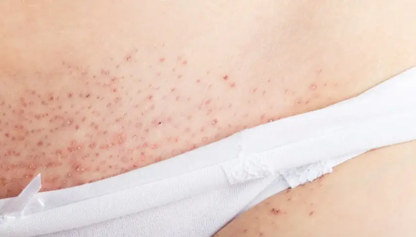 Hudirritation med små röda prickar och rakfinnar underlivet, synligt nära en vit troskant.