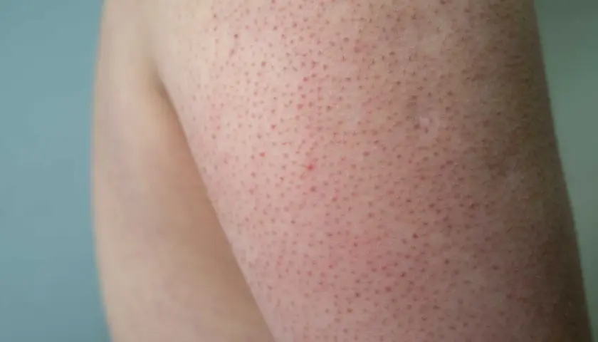 Närbild på hud med små röda prickar, liknande keratosis pilaris ansikte, på en arm.