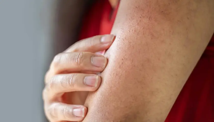 Nära bild på en arm med små knottror som tyder på keratosis pilaris. En hand rör vid huden.