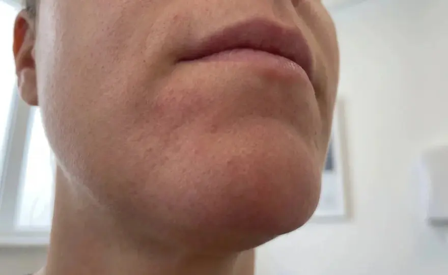Perioral dermatit & stress - Lugna huden: Din guide