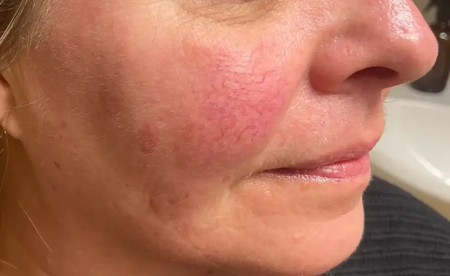 Rosacea hudvård - En lugn rutin som minskar rodnad