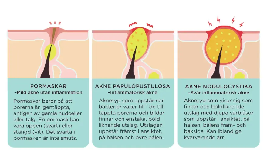 Finnar på halsen - Bli av med utslag & irritation