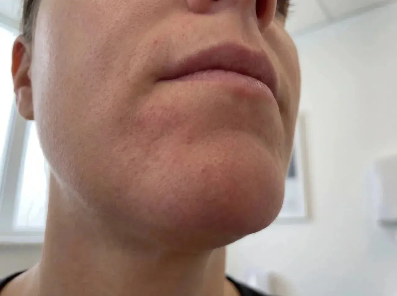När perioral dermatit stressar huden runt munnen syns rodnad och små utslag.