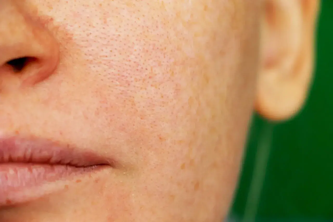 Närbild på en persons ansikte med synliga porer och pigmentfläckar, som visar effekterna av melasma behandling.