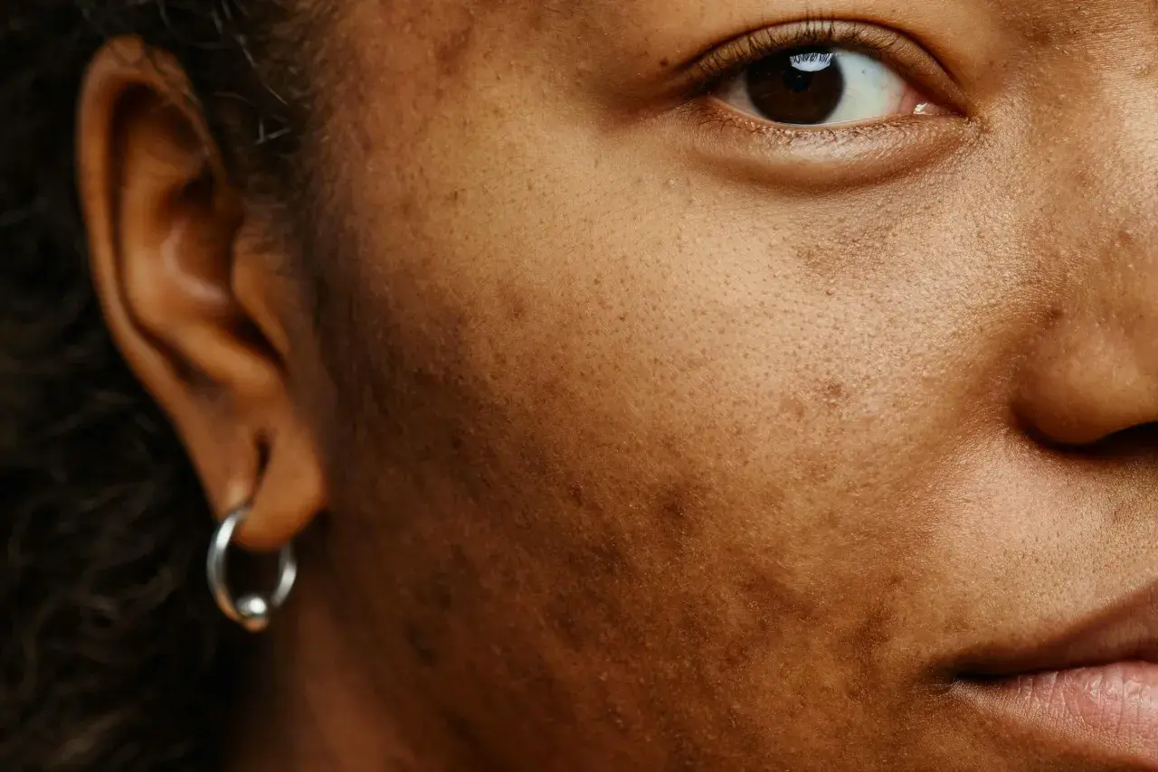 Närbild på en persons ansikte med mörk hudton, som visar ojämnheter och mörka fläckar. En silverfärgad örhänge syns i örat. Bilden kan illustrera behovet av hyperpigmentering behandling.