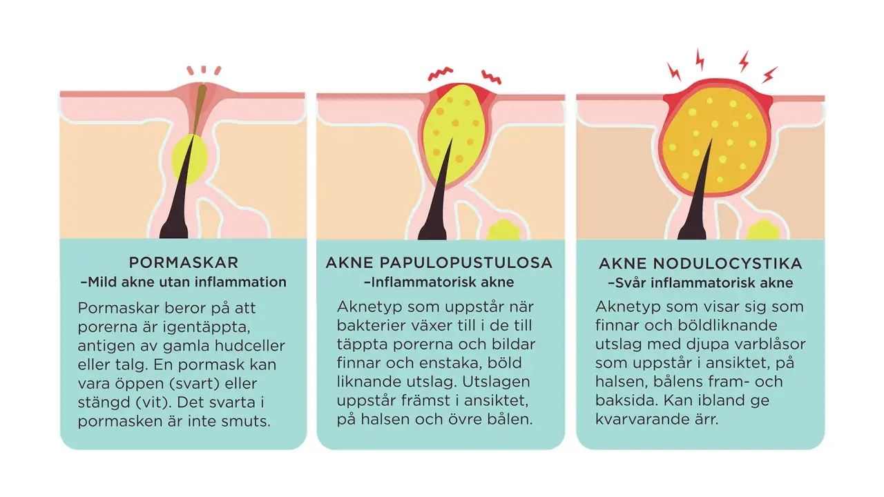 Illustrationer visar olika typer av finnar på huden, från milda pormaskar till svår akne med bölder. Finnar på halsen kan vara ett tecken på inflammatorisk akne.