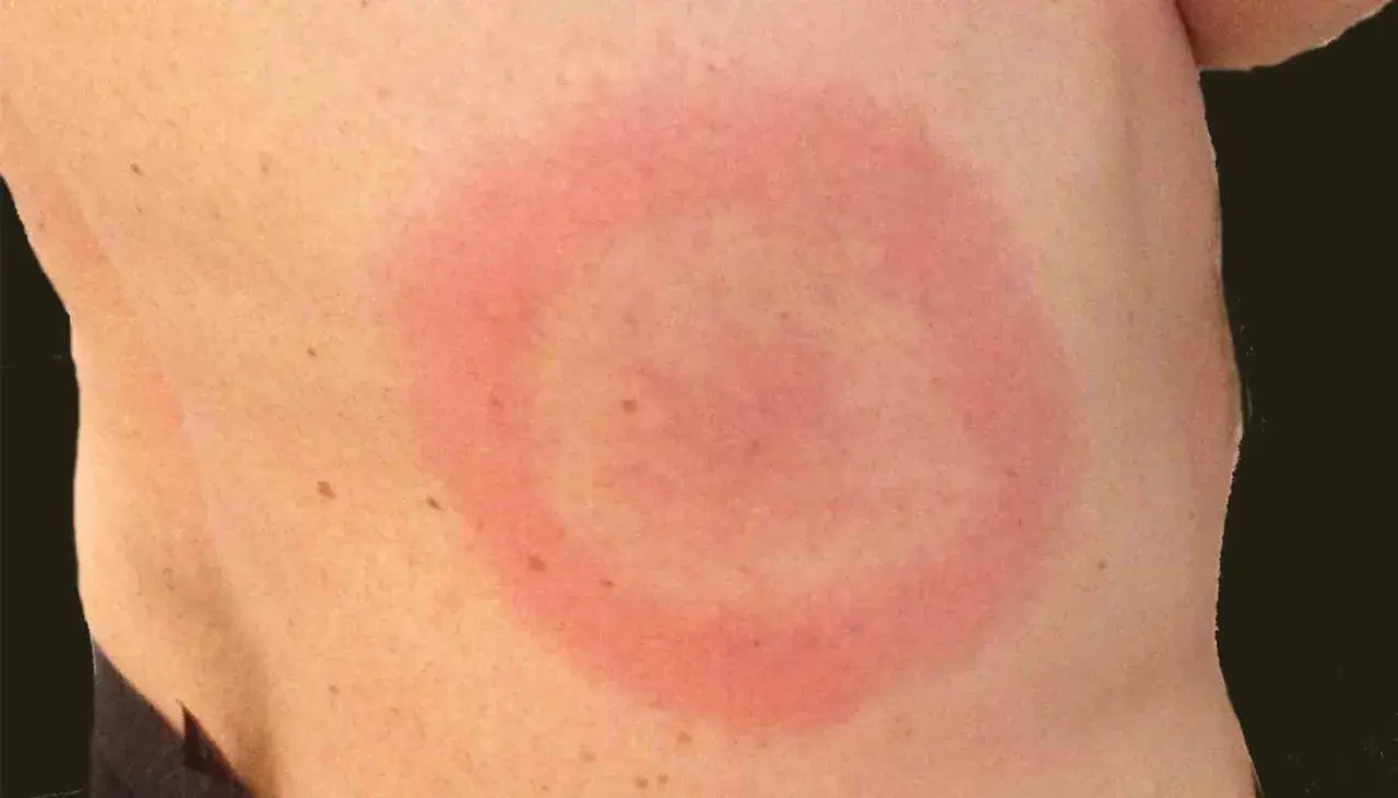 Rött, ringformat utslag på huden, misstänkt allergiska utslag.