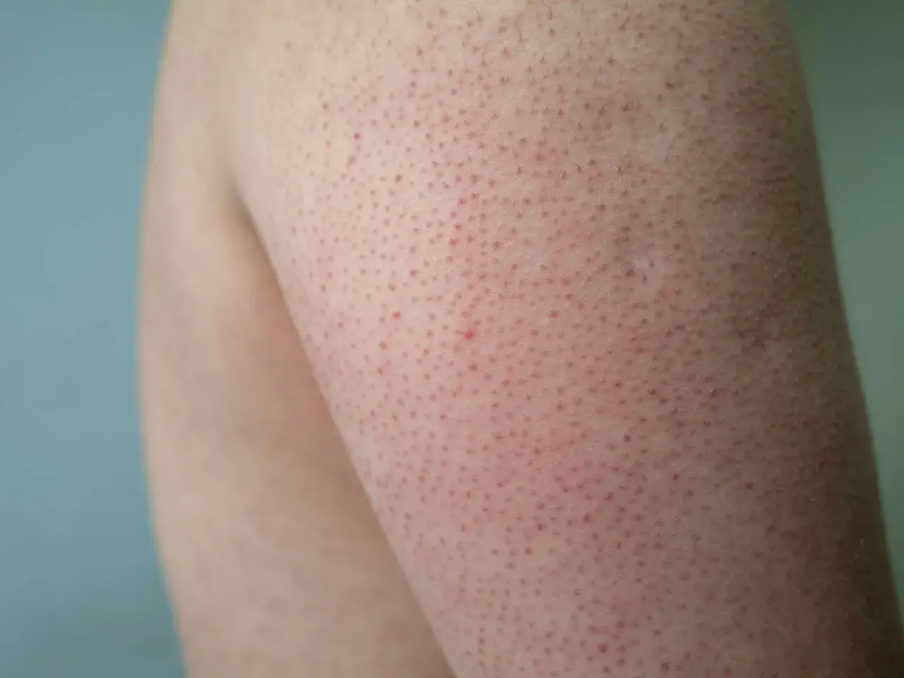 Närbild på hud med små röda prickar, liknande keratosis pilaris ansikte, på en arm.