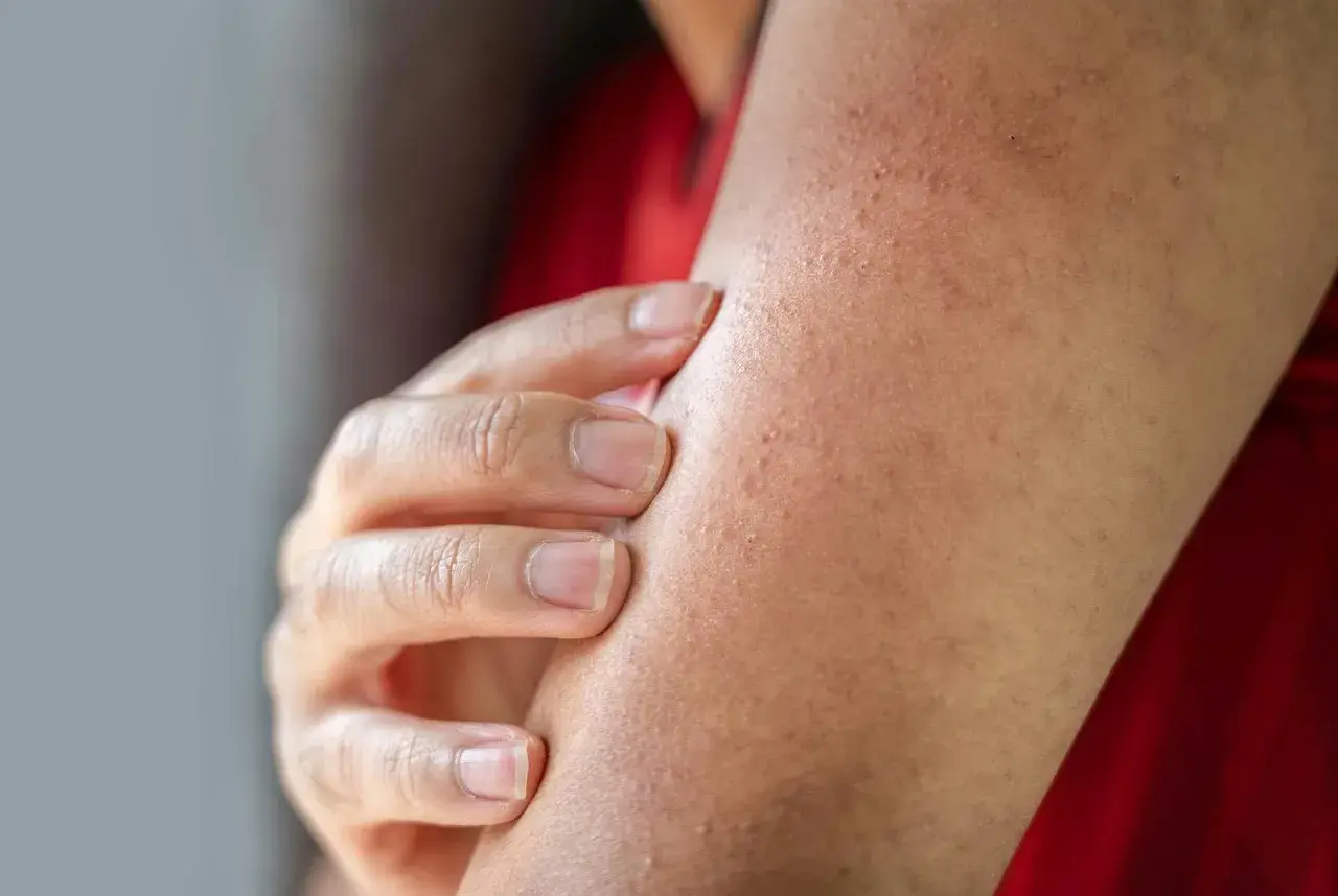 Nära bild på en arm med små knottror som tyder på keratosis pilaris. En hand rör vid huden.