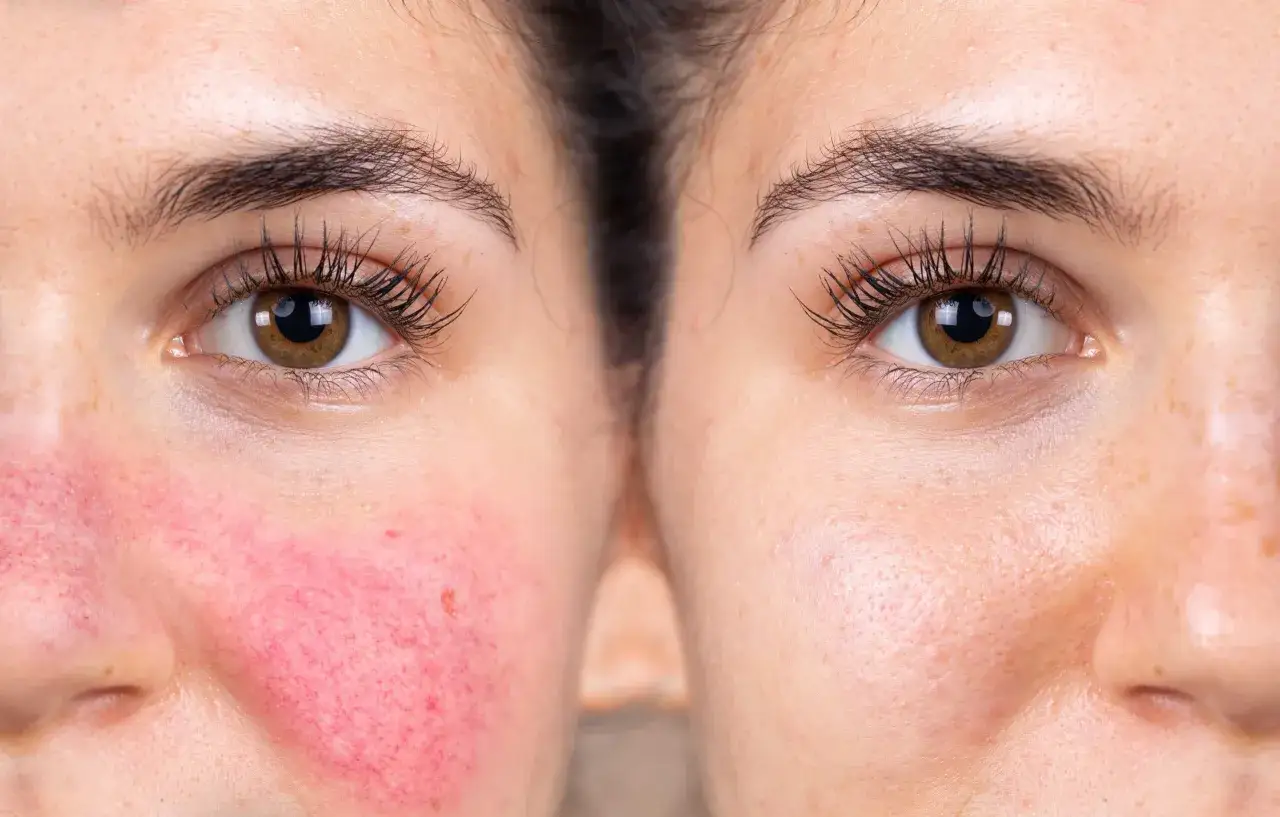 F&ouml;re- och efterbilder av en ansiktshalva som visar mild rosacea med rodnad och synliga blodk&auml;rl, j&auml;mf&ouml;rt med en klarare hud.