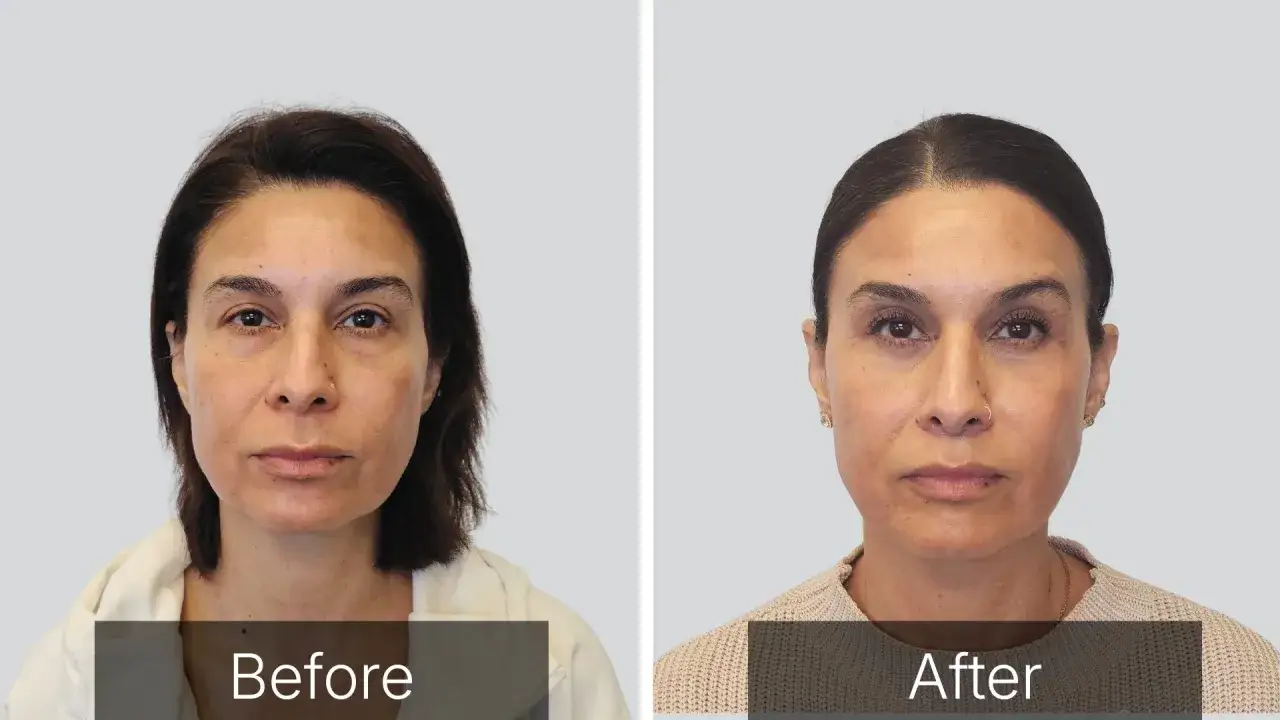 Före- och efterbilder visar en kvinna som genomgått en brow lift. Hennes ögonbryn ser lyftare och mer definierade ut efter ingreppet.