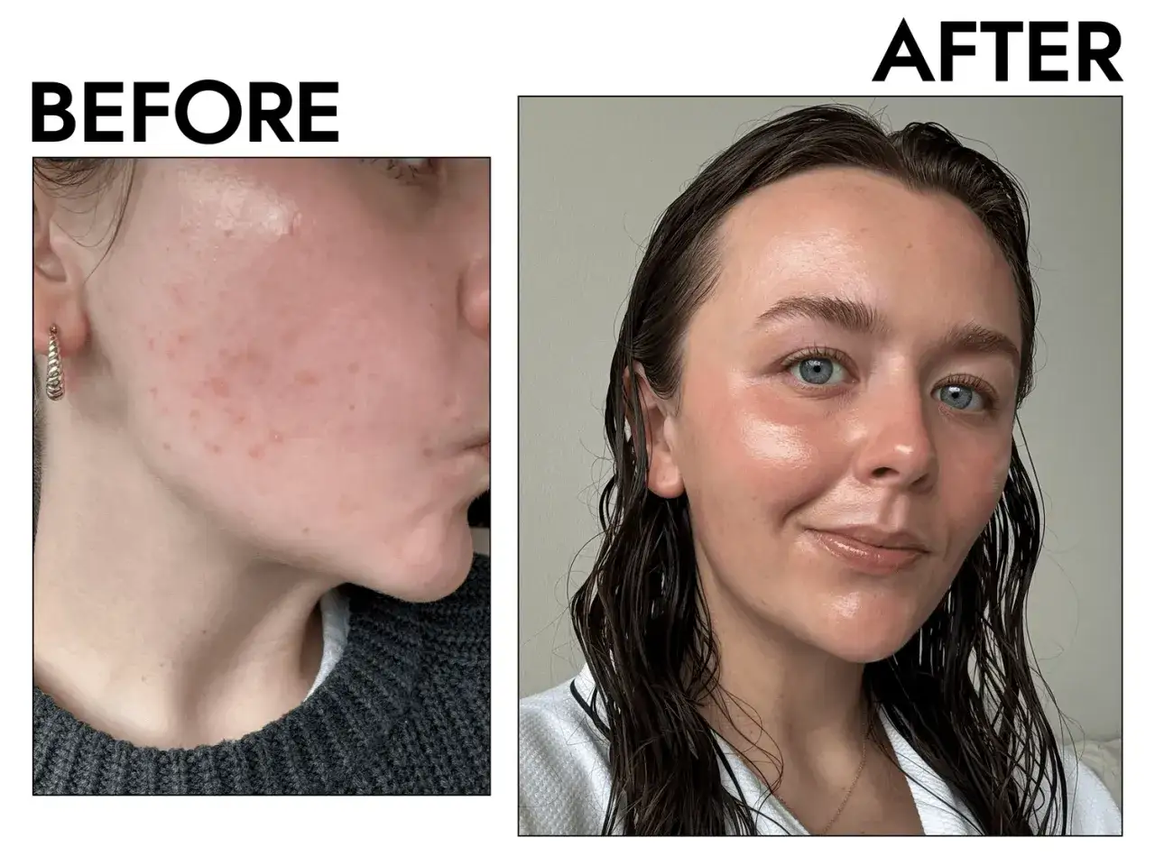 F&ouml;re och efterbilder visar en hud med akne som behandlats med retinol. Huden &auml;r nu klarare och j&auml;mnare.