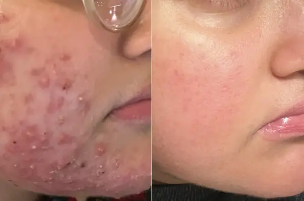 Före- och efterbilder visar hud med akne som blivit slät. En fin, rak mustasch kan nu framhävas.